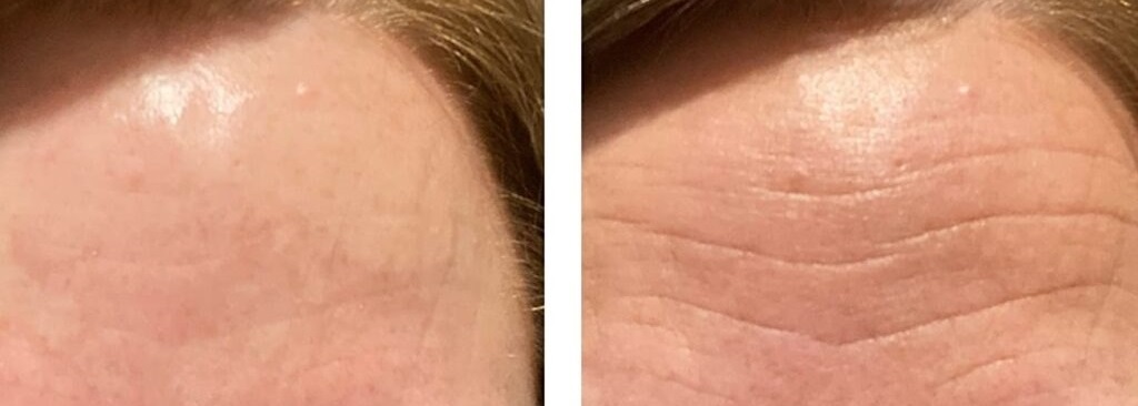 what are the best forehead wrinkle patches?